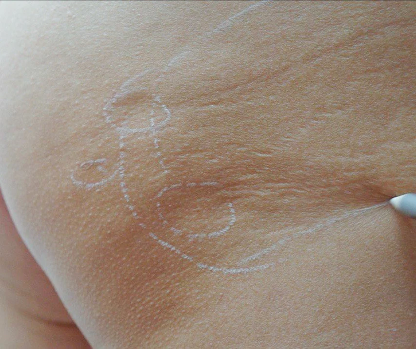 Sculptra. Способ маркировки втяжений