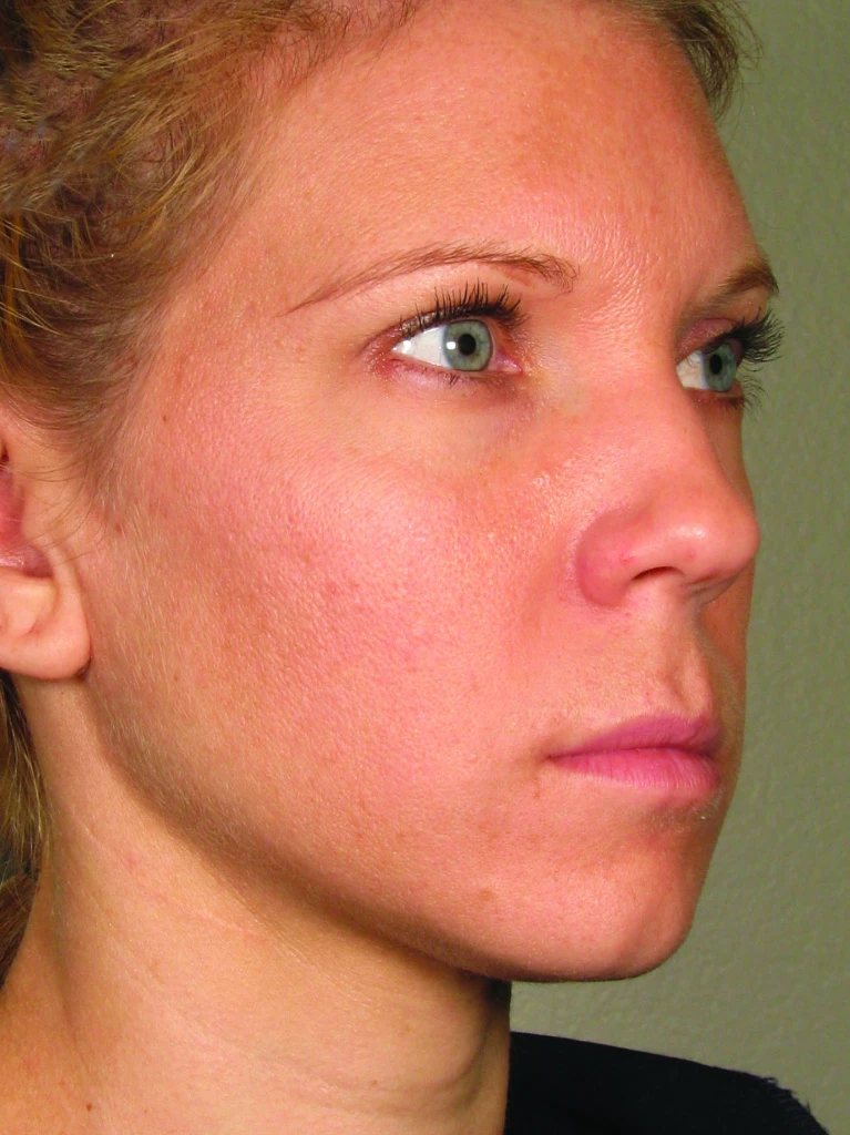 Ultherapy После