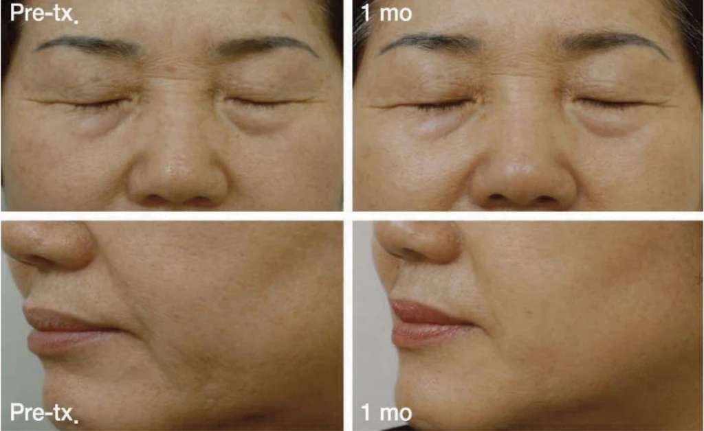 До и после Scarlet RF