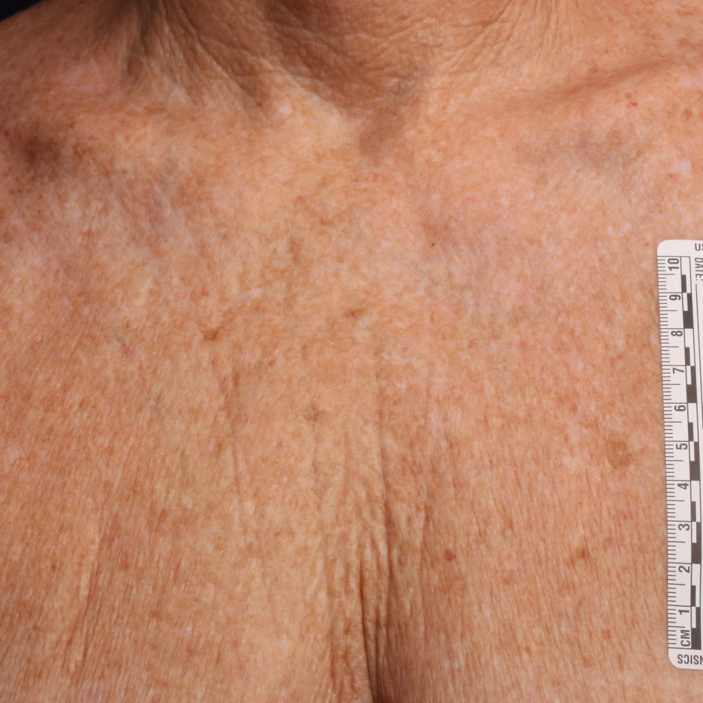 Ultherapy До
