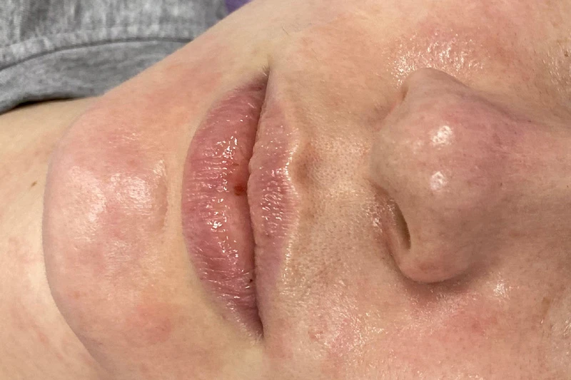 Водородный гидропилинг Hydra Touch H2