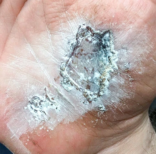 EpiDermG применение
