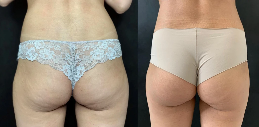 коррекция на аппарате Accent, фото до и после