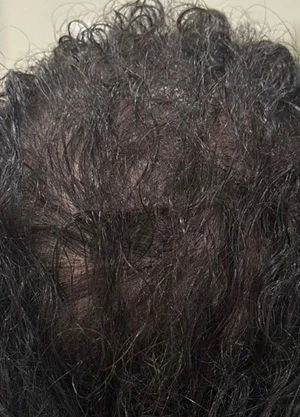 Sylfirm X в лечении алопеции, фото до