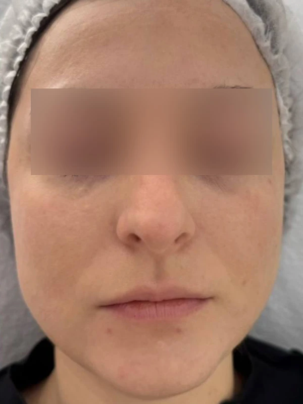 Лазерное лечение гиперпигментации: фото после