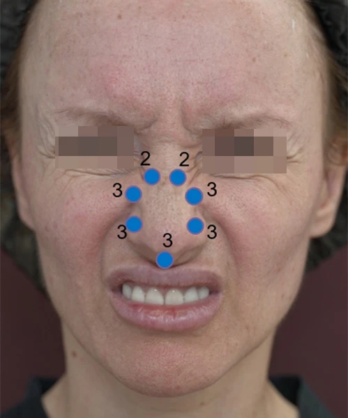 Коррекция препаратом Belotero