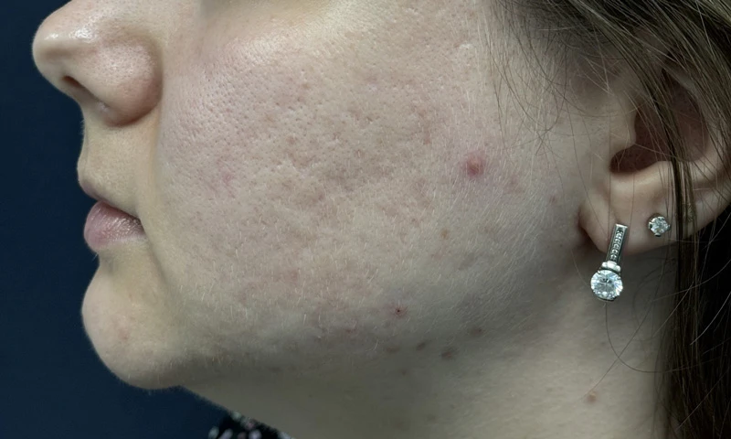 Комбинация пилинга B-Twin System и PRP Cellenis