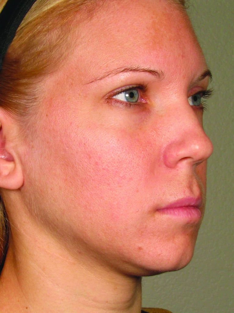 Ultherapy До