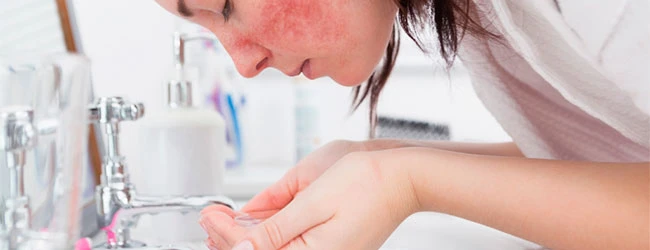 Лечение розацеа