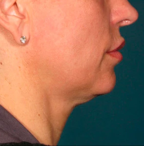 Фото до процедуры Ultherapy