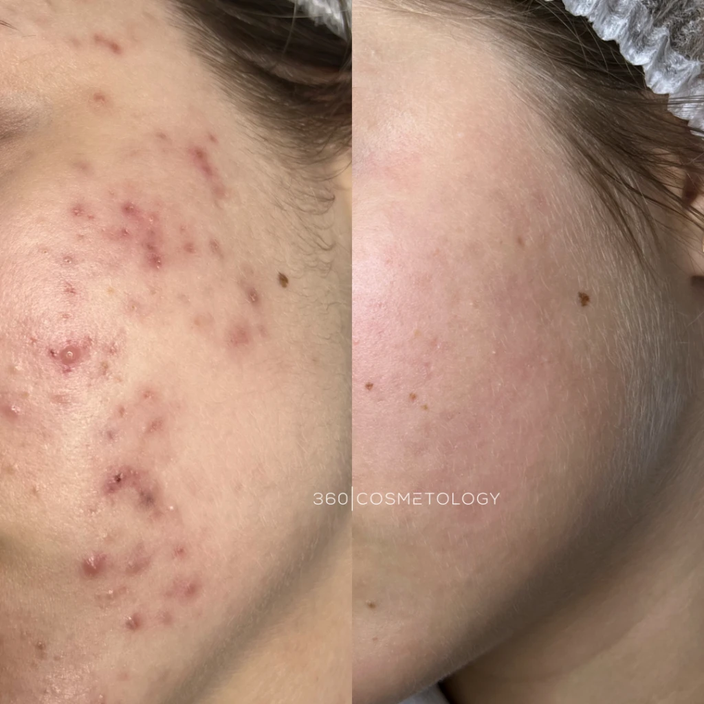 терапия HELEO4™