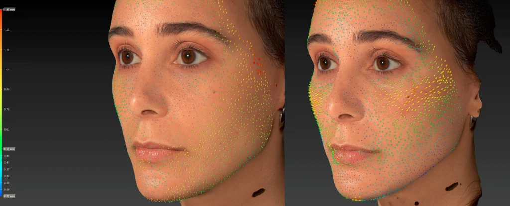 Техника В.UP филлерами Belotero