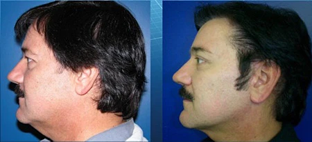 лигатурный лифтинг до и после, лигатурный лифтинг