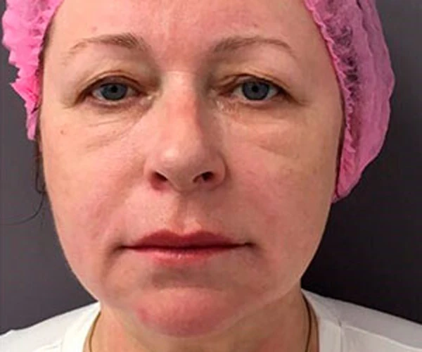 Абляционная фракционная радиочастота