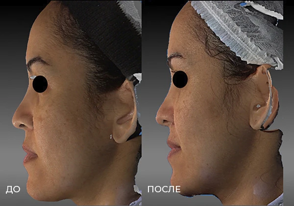 Заднетемпоральный лифтинг