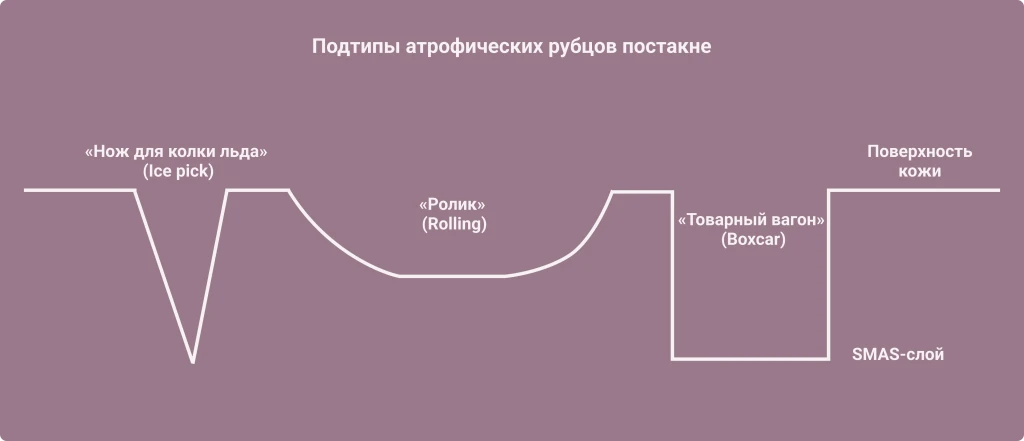 Подтипы атрофических рубцов постакне