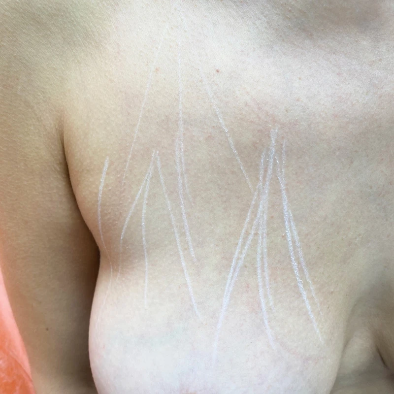 Sculptra разметка руки