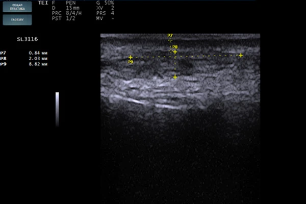 Сонограмма дермального имплантата
