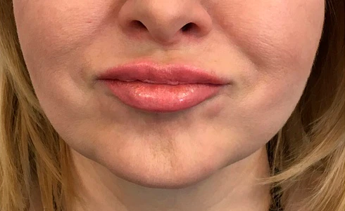 Ксеомин, Подбородочная мышца