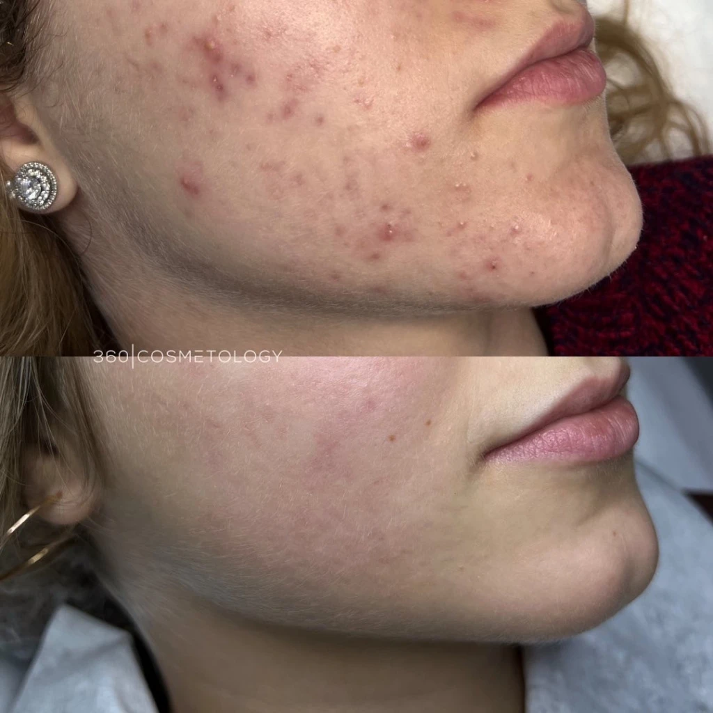 терапия HELEO4™