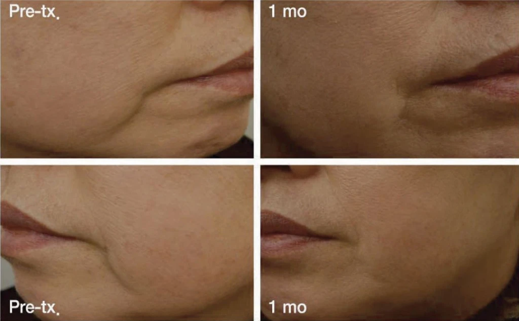 До и после Scarlet RF