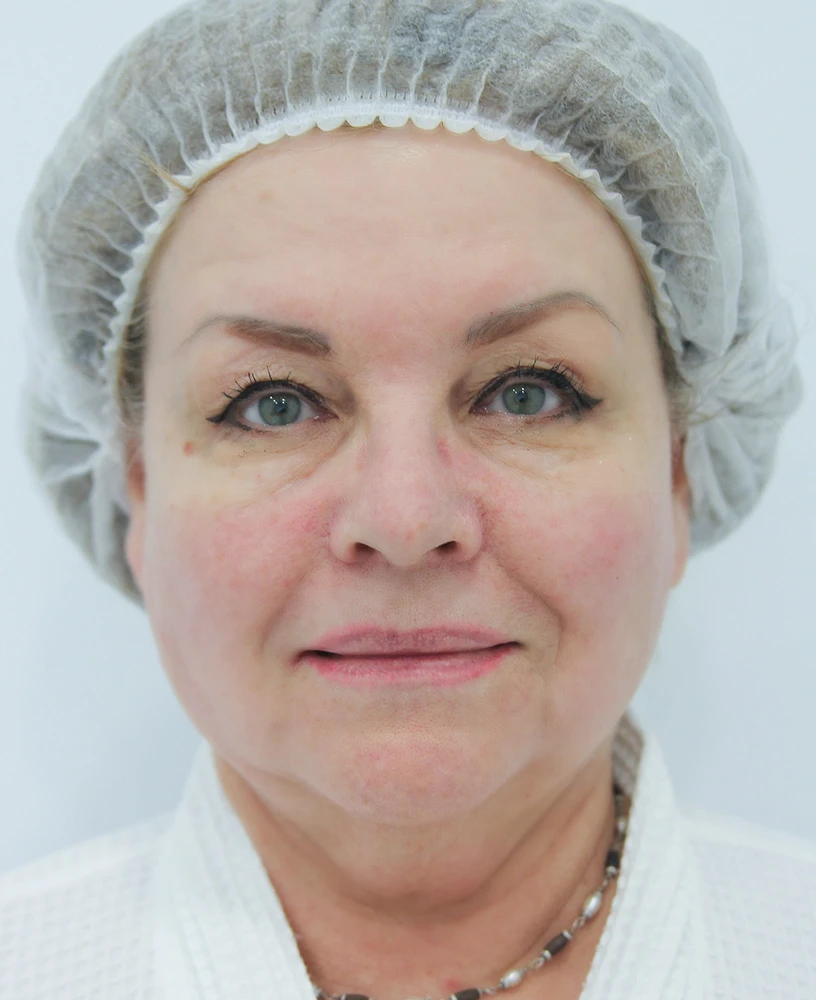 Комбинированный протокол Dye-VL с ClearLift, фото ПОСЛЕ процедуры