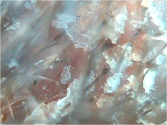 Себорейный дерматит на фоне эритемы