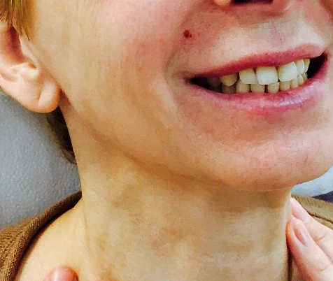 Ксеомин, Тяжи платизмы