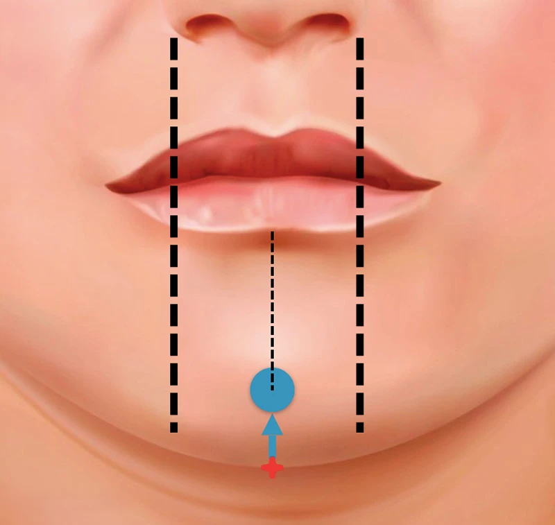 коррекция подбородка, разметка, Restylane Perlane