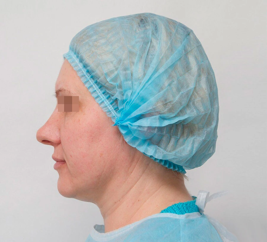 Применение Ultherapy