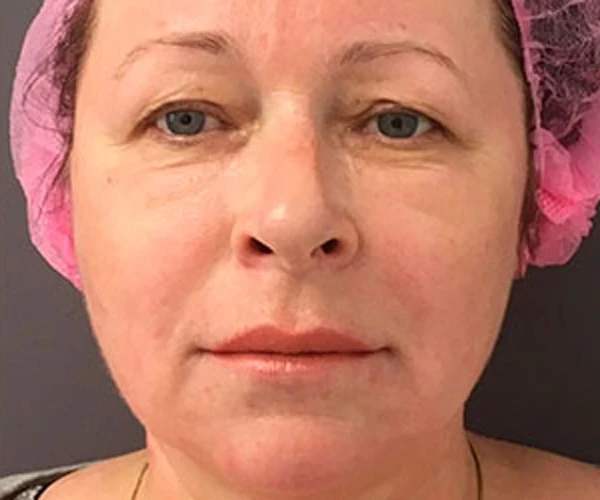 Абляционная фракционная радиочастота