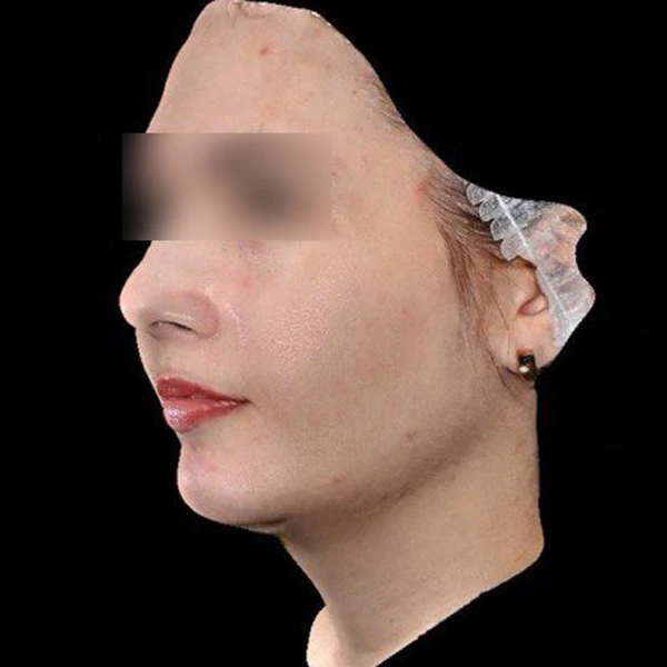 Лазерное лечение гиперпигментации: фото после