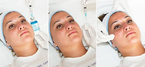 EASY-PHYTIC PEEL, протокол примения