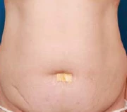 до липосакции