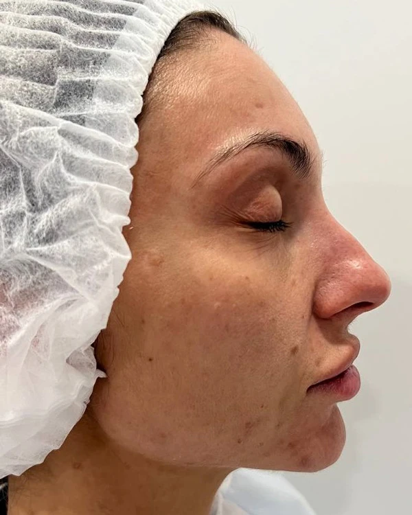 Calecim Professional Serum
