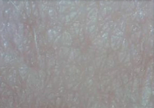 Комбинированный протокол: пилинг и биоревитализант