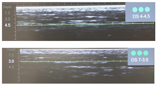 Диагностическая визуализация субментальной зоны