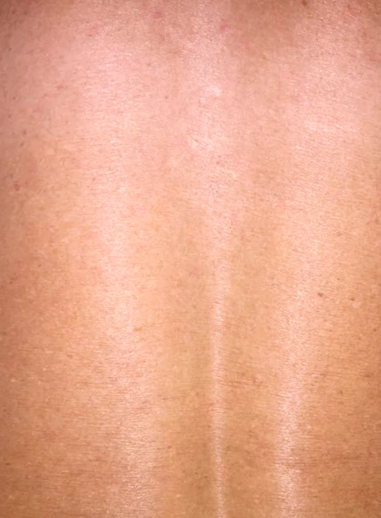 Радиочастотный лифтинг Scarlet RF, фото после