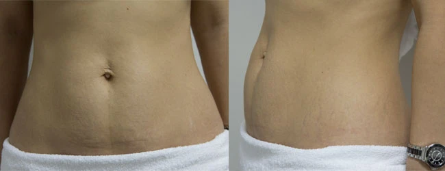 Клиническая картина стрий