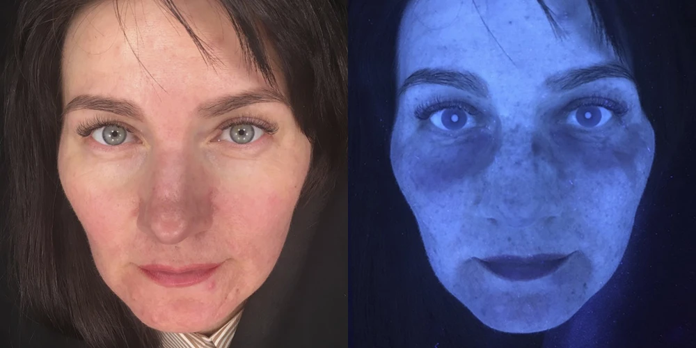 Acne vulgaris, папуло-пустулезная форма умеренной степени тяжести