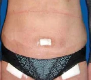 после липосакции