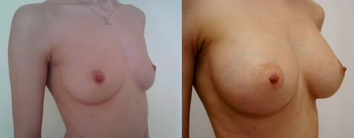 Увеличение груди (Доктор: Ф. Н. Мистакопуло)