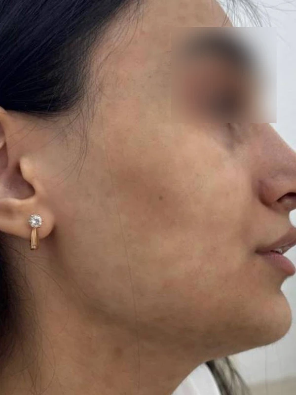 Лазерное лечение гиперпигментации: фото до