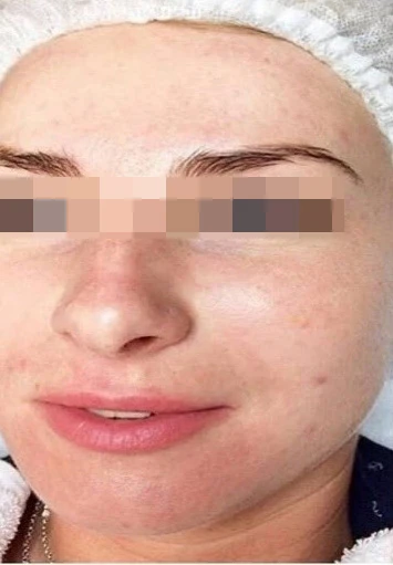 Acless spot peel
