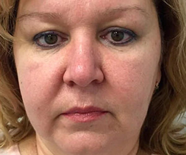 Микротоковый дренаж против малярных мешков