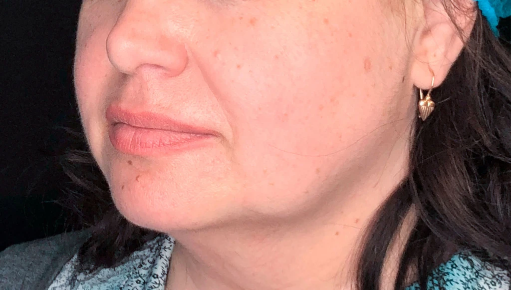 Применение Ultherapy