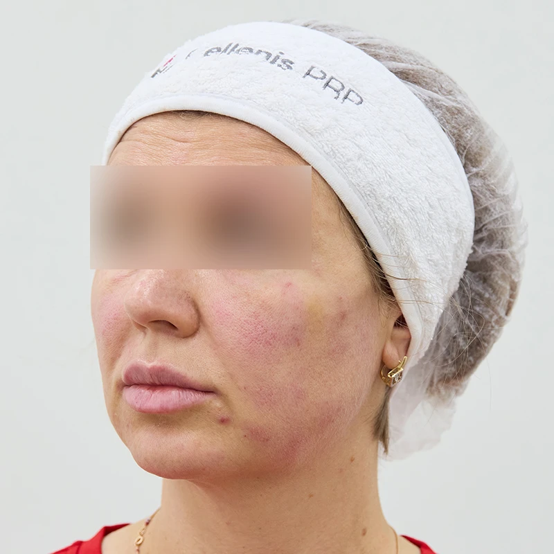Neauvia и Cellenis PRP