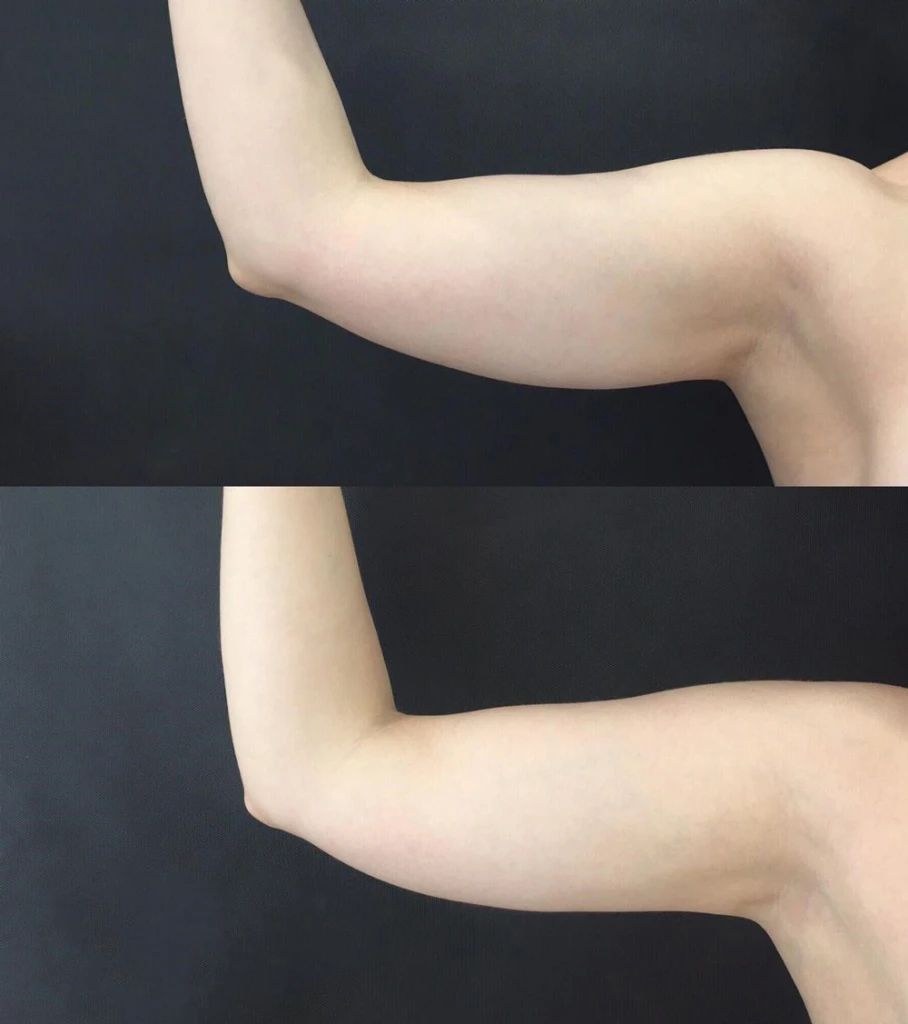 коррекция на аппарате Clatuu, фото до и после