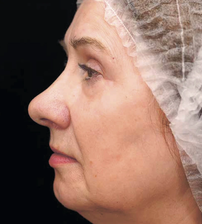 Bioregen + CO₂-лазер