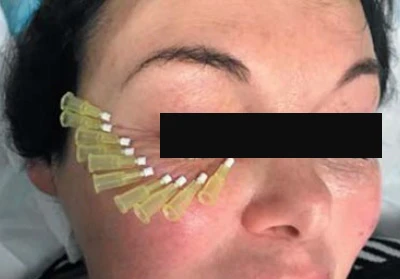 Микронити DG-lift (31G, 30G)